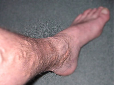 Complications-of-Varicose-Veins