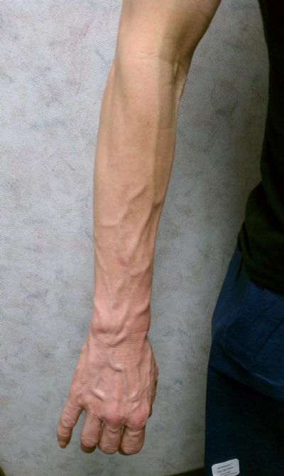 How to Get Rid Of Varicose Veins In Your Arms